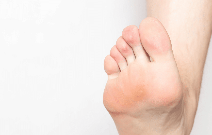 Cómo eliminar los callos de los pies